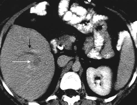 Irrigation Of The Bile Ducts With Chilled Saline During Percutaneous