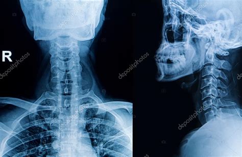 X-ray image of cervical spine, neck x-ray image — Stock Photo ...