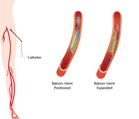 Peripheral Angioplasty Dr Raghu