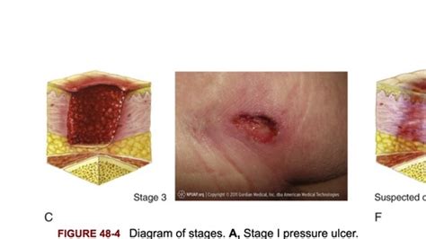 Pressure Ulcers Flashcards Quizlet