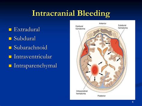 Bleeding In The Brain Intracranial Bleeding Pictures