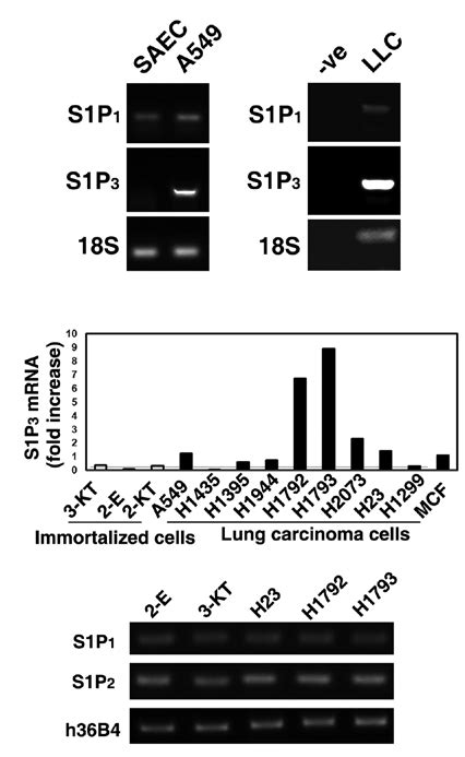 Increased Expression Of S1P 3 In Cultured Human Lung Adenocarcinoma