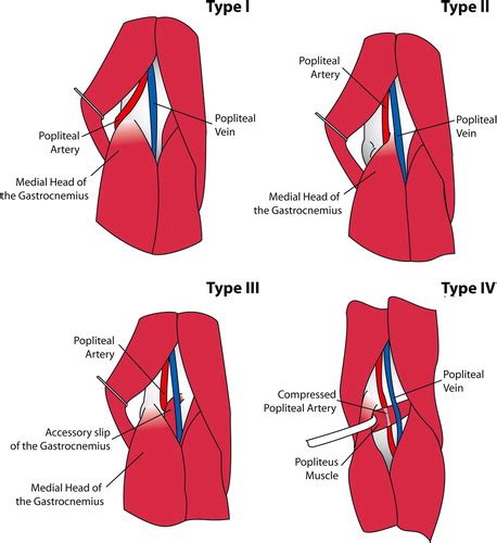 Popliteal Artery Disease Diagnosis And Treatment Radiographics