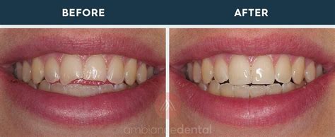 What Is Dental Bonding Ambiance Dental