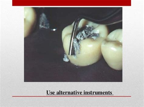 procedure for amalgam restoration