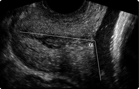 Ultrasound Of Normal Cervix Trialexhibits Inc