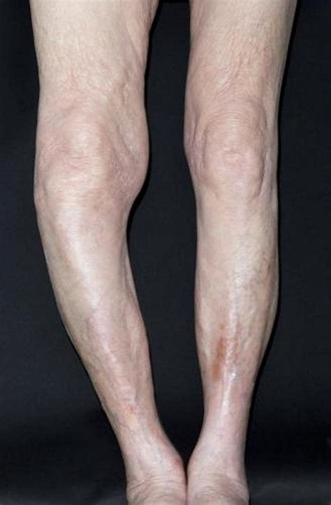 Paget Disease of Bone - Musculoskeletal and Connective Tissue Disorders