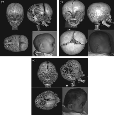 Head Computed Tomography Scan 3 Dimensional Reconstruction With Axial Download Scientific