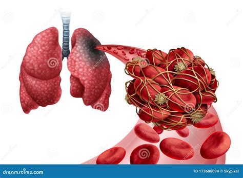 Pulmonary Edema Cartoons, Illustrations & Vector Stock Images - 24341 Pictures to download from ...