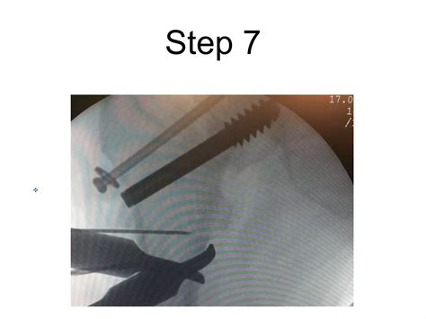 Valgus Or Abduction Osteotomy For Non Union Femur Ppt