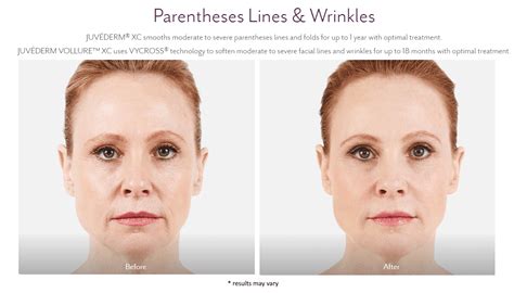 Juvederm Before And After Pictures Juvederm Westport Ct