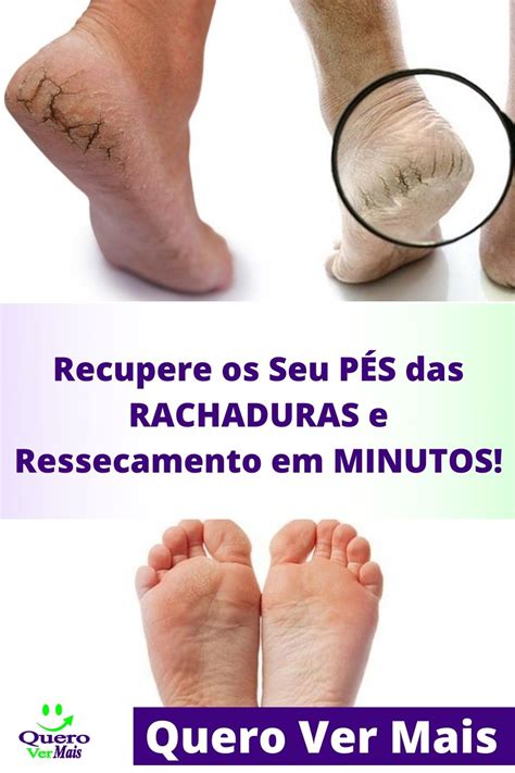 Rachadura Nos Pés O Que Pode Ser - Recupere os Seu PÉS das RACHADURAS e Ressecamento em MINUTOS! | Quero ...