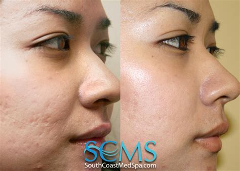 Los Angeles Laser Acne Scar Removal: Laser Acne Scar Removal