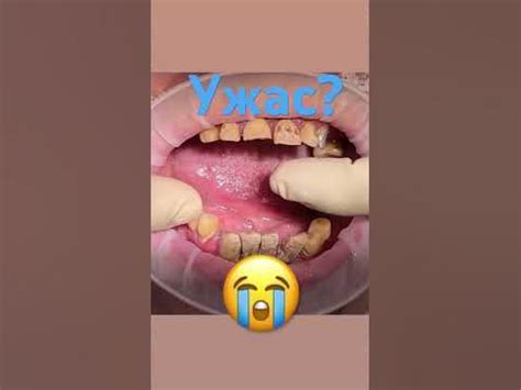 Гнилые зубы? Ужас 😨 ужас 😧 #шортс #зубы #медицина - YouTube