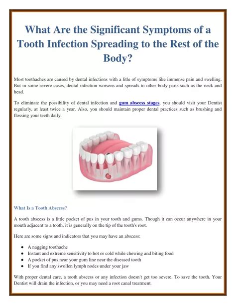 Ppt What Are The Significant Symptoms Of A Tooth Infection Spreading