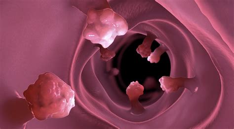 Bakterie I Tarmen Kopplad Till Tjocktarmscancer H Lsa Funktionsmedicin