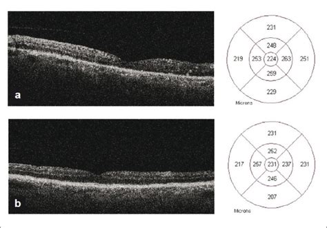 Stratus Time Domain Optical Coherence Imaging Prior To Onset Of Central Download Scientific