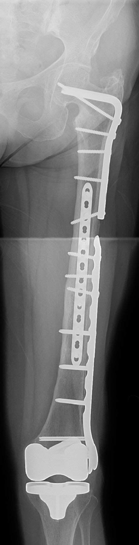 Orthogonal Femoral Plating Bone Joint