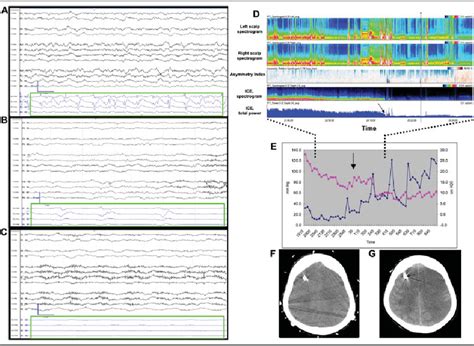 Electroencephalographic Eeg And Multimodality Monitoring In A