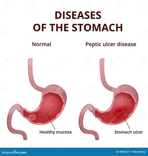 What Does The Inside Of A Healthy Stomach Look Like at Rachel Stearn blog