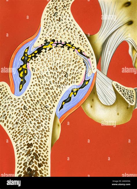 Hip Joint Cartilage Loss Illustration Showing The Destruction And Loss