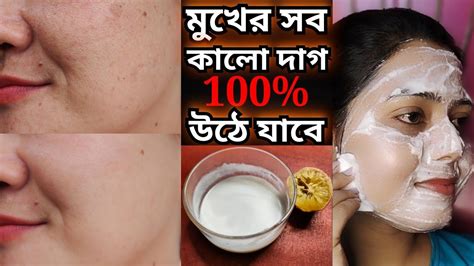 Skin Whitening Challenge ব্রণর দাগ মেছেতার দাগ ও মুখের যেকোনও কালো