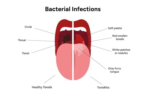 Premium Vector Bacterial Infections Tonsillitis And Healthy Tonsils