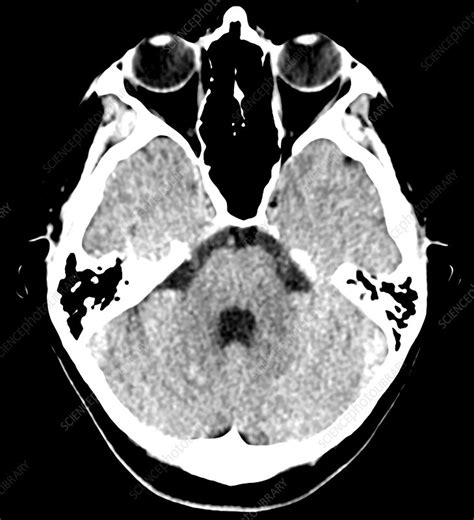 Large Developmental Venous Anomaly Ct Scan Stock Image C