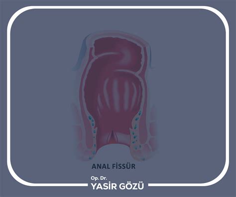 Anal Fissür Tedavisi Op Dr Yasir Gözü
