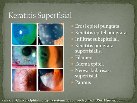 Ppt Keratitis Dan Ulkus Kornea Powerpoint Presentation Free Download