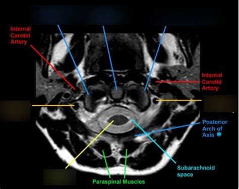 Cervical MRI Axial 1 Diagram | Quizlet