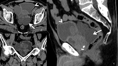 An Unenhanced Computed Tomography Ct Scan Of The Abdomen And Pelvis Download Scientific