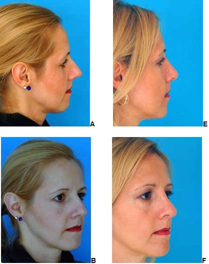 New Technology And Cutting Edge Advances In Rhinoplasty