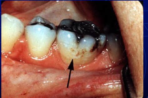 Caries Radiology Flashcards Quizlet