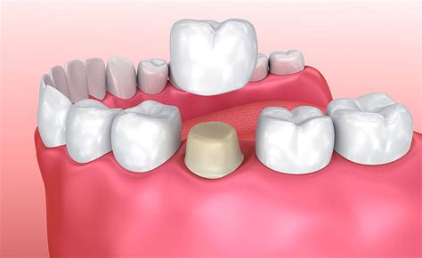 Why Porcelain/All-Ceramic Crowns are Better | Dentist Office Beaufort SC