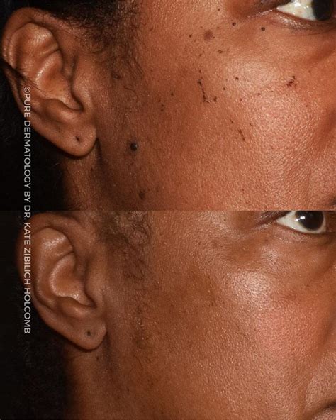 Skin Of Color Pure Dermatology Metairie LA