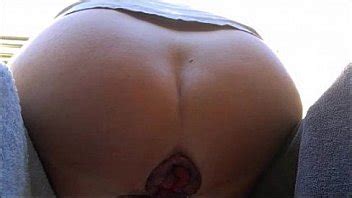 Close Up From My Extreme Anal Gape And Prolaps XNXX