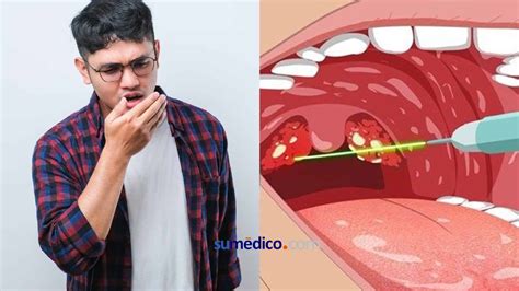 Bolitas Blanca En La Boca Hot Sale Pacificproductsandservices