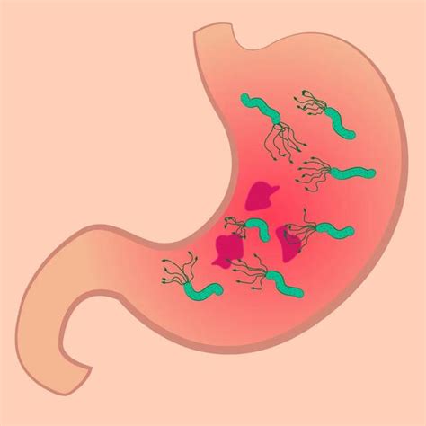 感染幽門螺桿菌，確實會增加胃癌風險 每日頭條