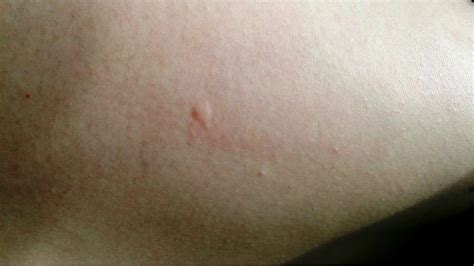 Skin Cancer Causes