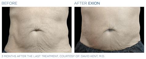 Stretch Mark Treatment Pulse Body Rejuvenation Adelaide