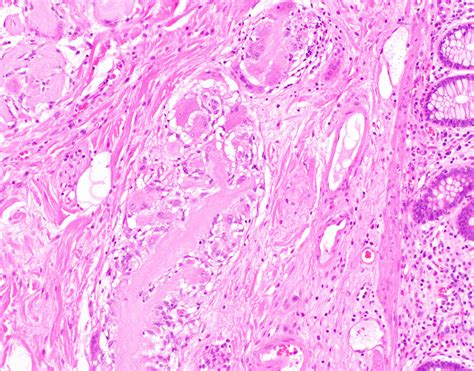 Pathology Outlines Lifting Agent Granuloma