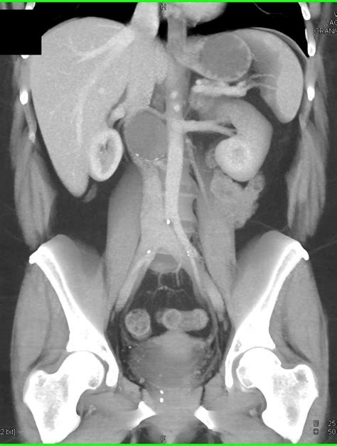 Schwannoma In The Right Para Aortic Region Gastrointestinal Case