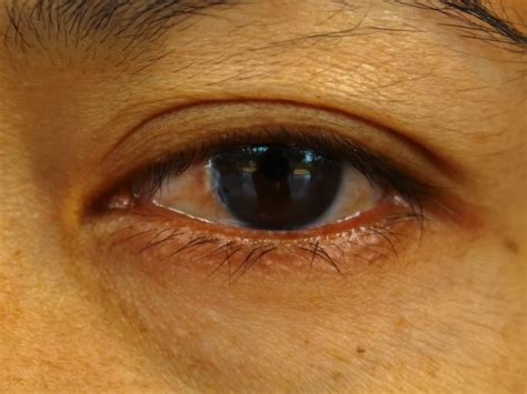 Pterygium Excision The Eye Surgeon