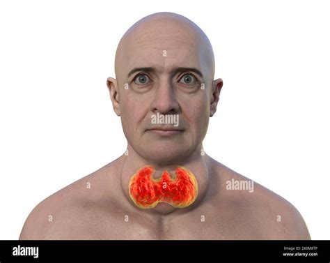 3d Illustration Of A Man With An Enlarged Thyroid Gland Goitre Base