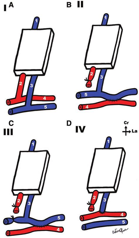 Abcd Schematic Representation Of The Vascular Patterns In The