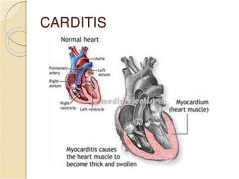 Acute Rheumatic Fever