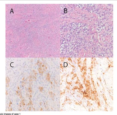 Figure From Uterine Tumour Resembling Ovarian Sex Cord Tumour Utrosct Experience With A