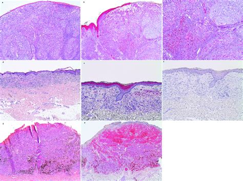 vascular endothelial growth factor  vegf vegfr   vegfr