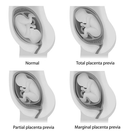 Placenta Previa First Trimester